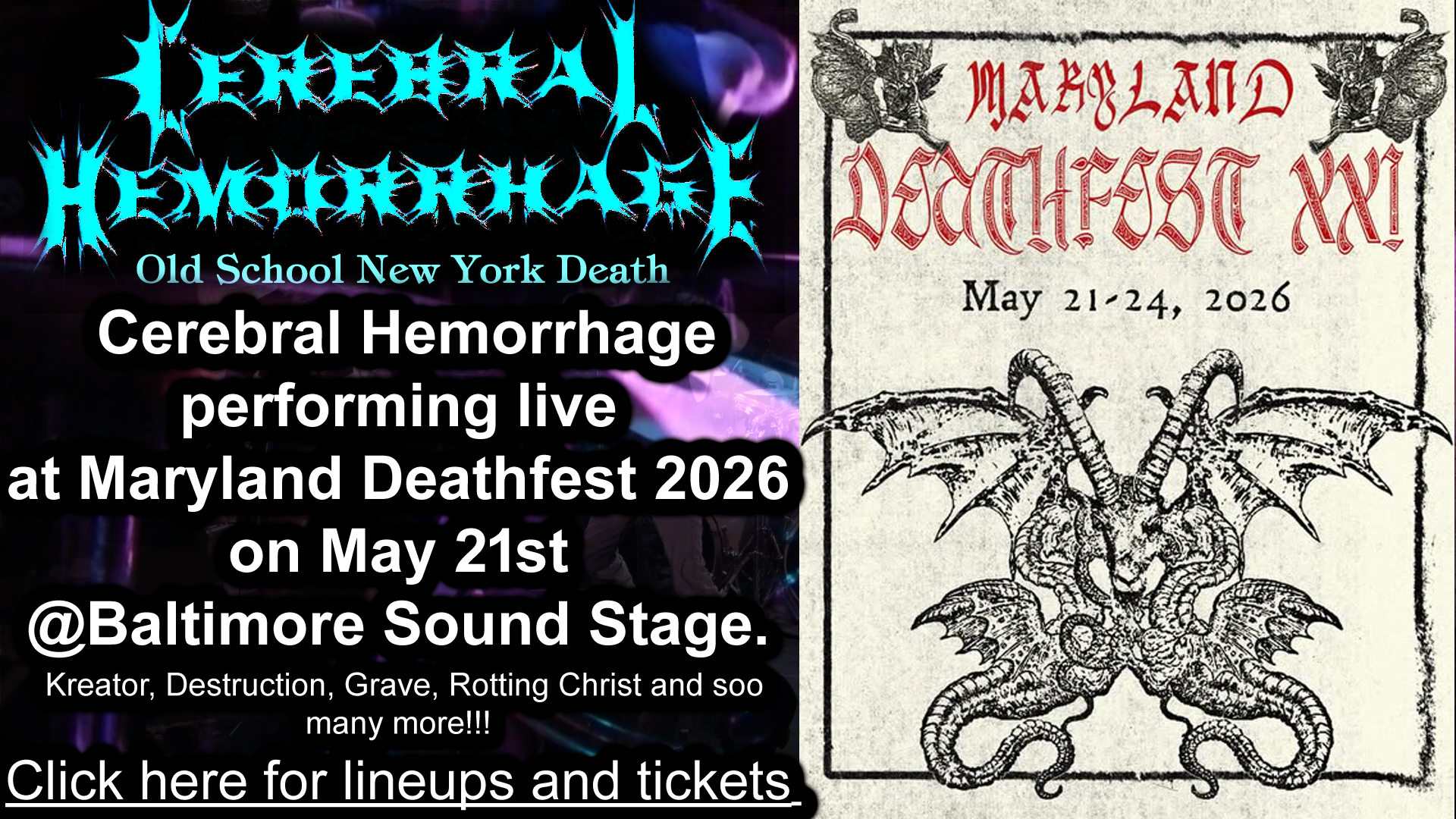 Cerebral Hemorrhage MDF 2026